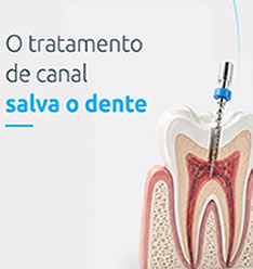 Edondontia, tratamento de canal.